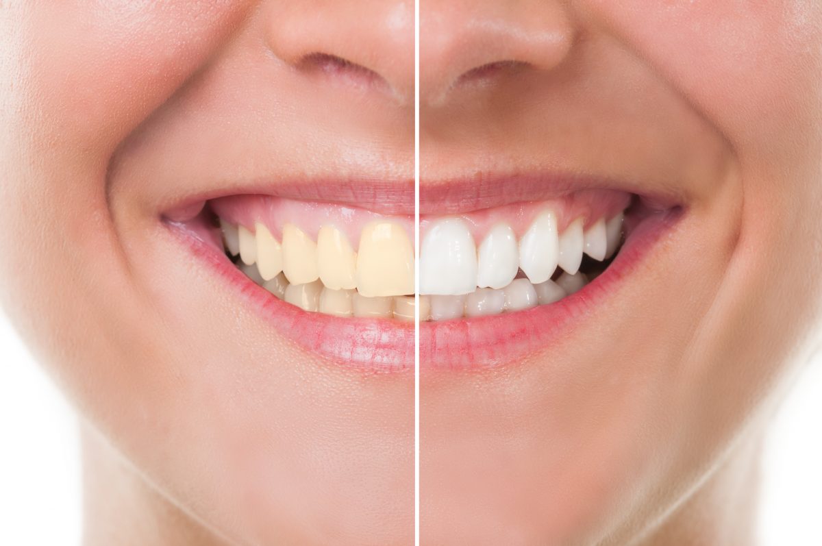 teeth whitening watertown mn