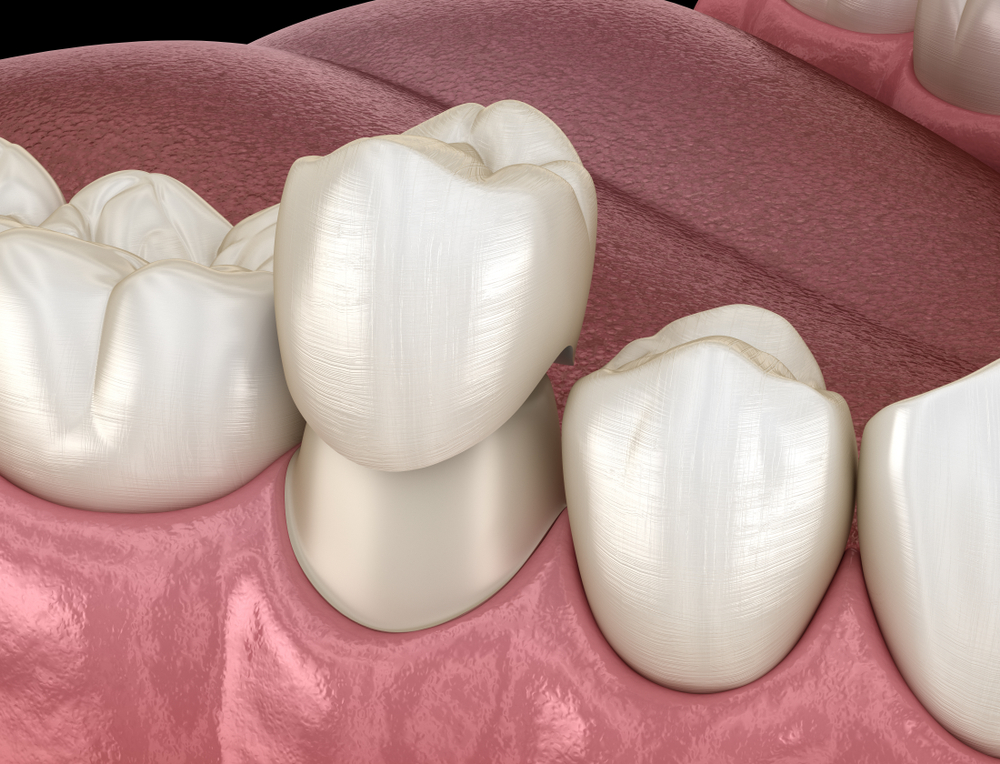 Dental Crowns Cost in Watertown MN