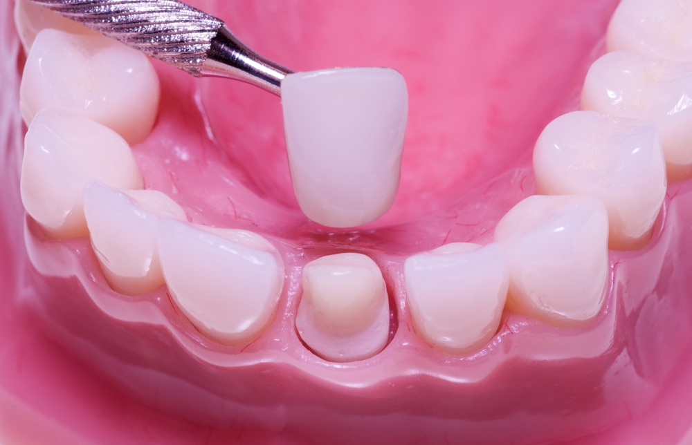 Types of Dental Crowns, Which To Choose | Watertown MN