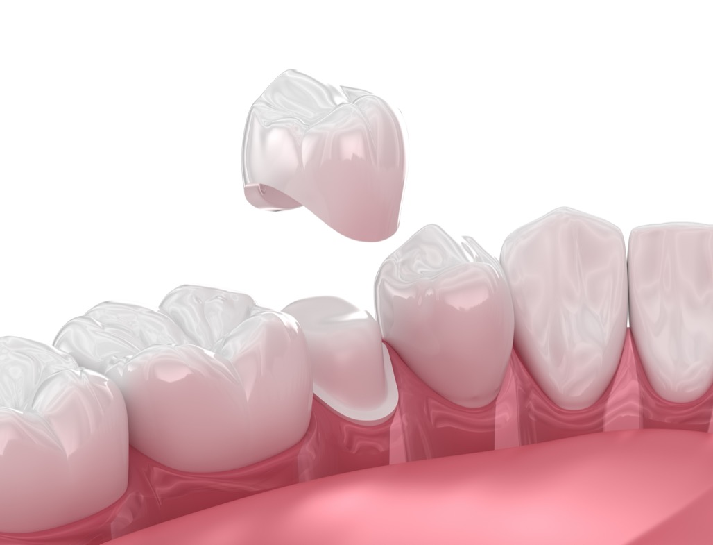 Dental Crowns Near Me in Watertown