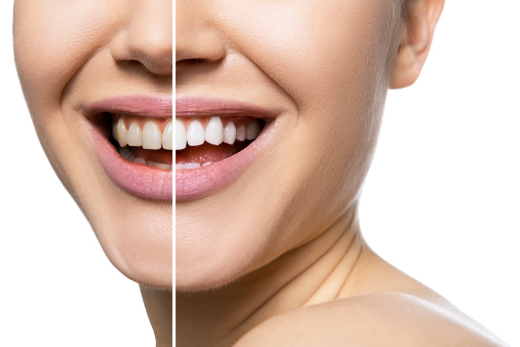 Teeth Whitening Treatment in Watertown