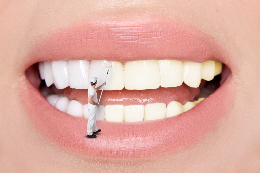 Teeth Whitening Treatment in Watertown