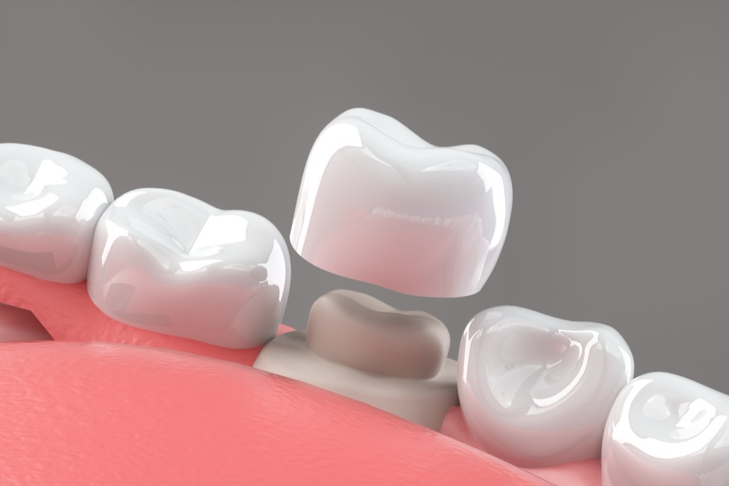 Dental Crowns Near Me in Watertown