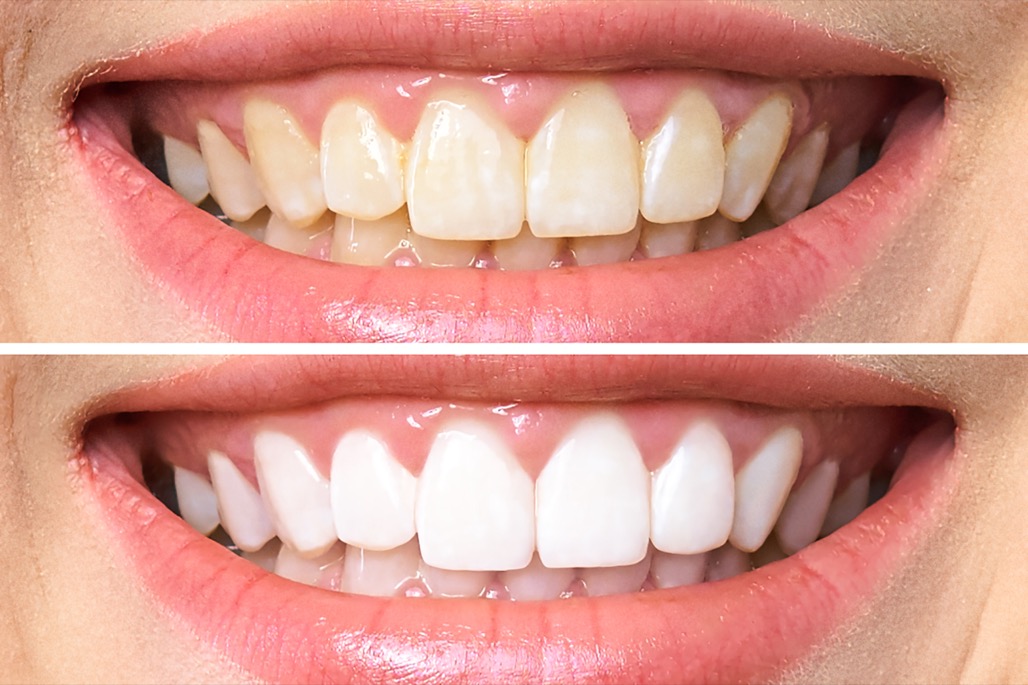 Teeth Whitening Treatment in Watertown