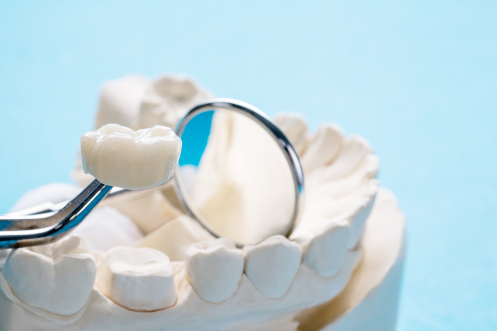 What Is A Dental Crown? Watertown